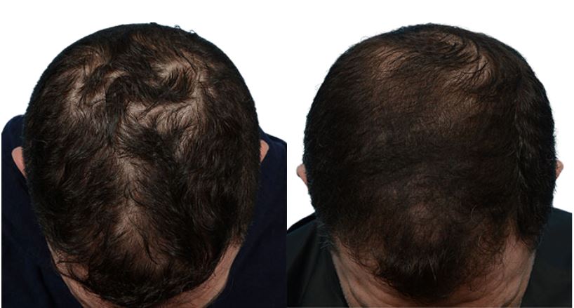Platelet-Rich-Plasma Before & After Gallery - Patient 267152 - Image 1