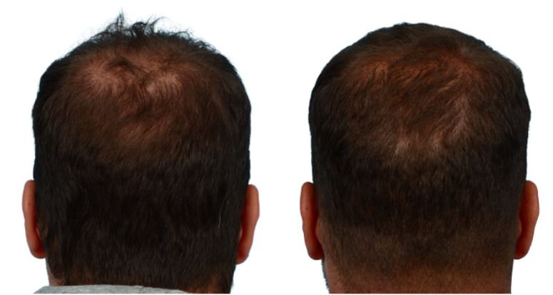 Platelet-Rich-Plasma Before & After Gallery - Patient 996866 - Image 2