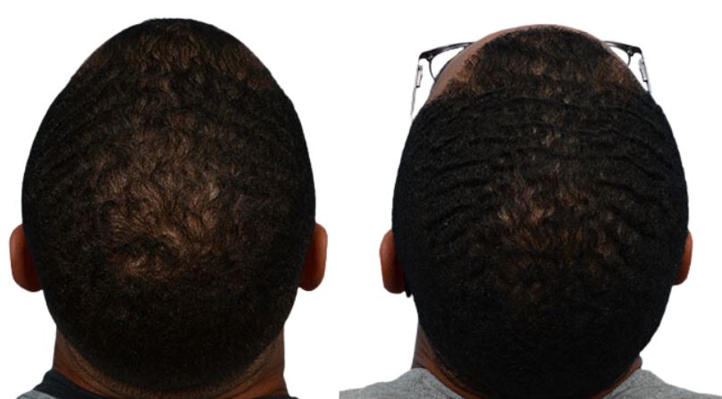 Platelet-Rich-Plasma Before & After Gallery - Patient 475229 - Image 2