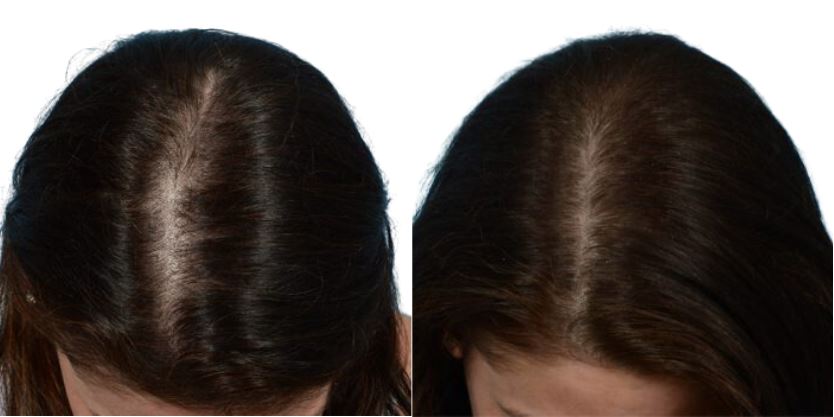 Platelet-Rich-Plasma Before & After Gallery - Patient 753038 - Image 1