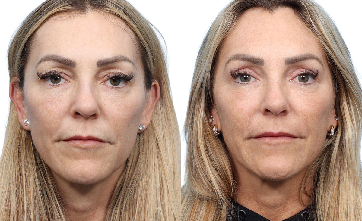 Blepharoplasty (Eyelid Surgery) Before & After Gallery - Patient 411628 - Image 1