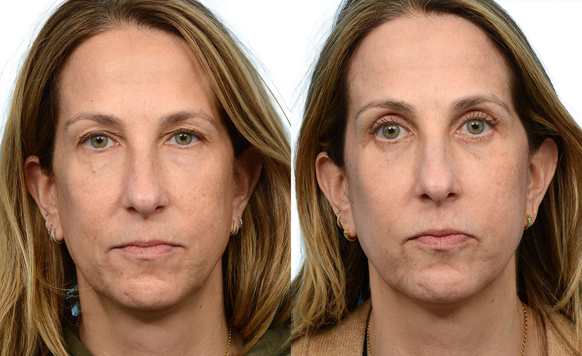Blepharoplasty (Eyelid Surgery) Before & After Gallery - Patient 379998 - Image 1