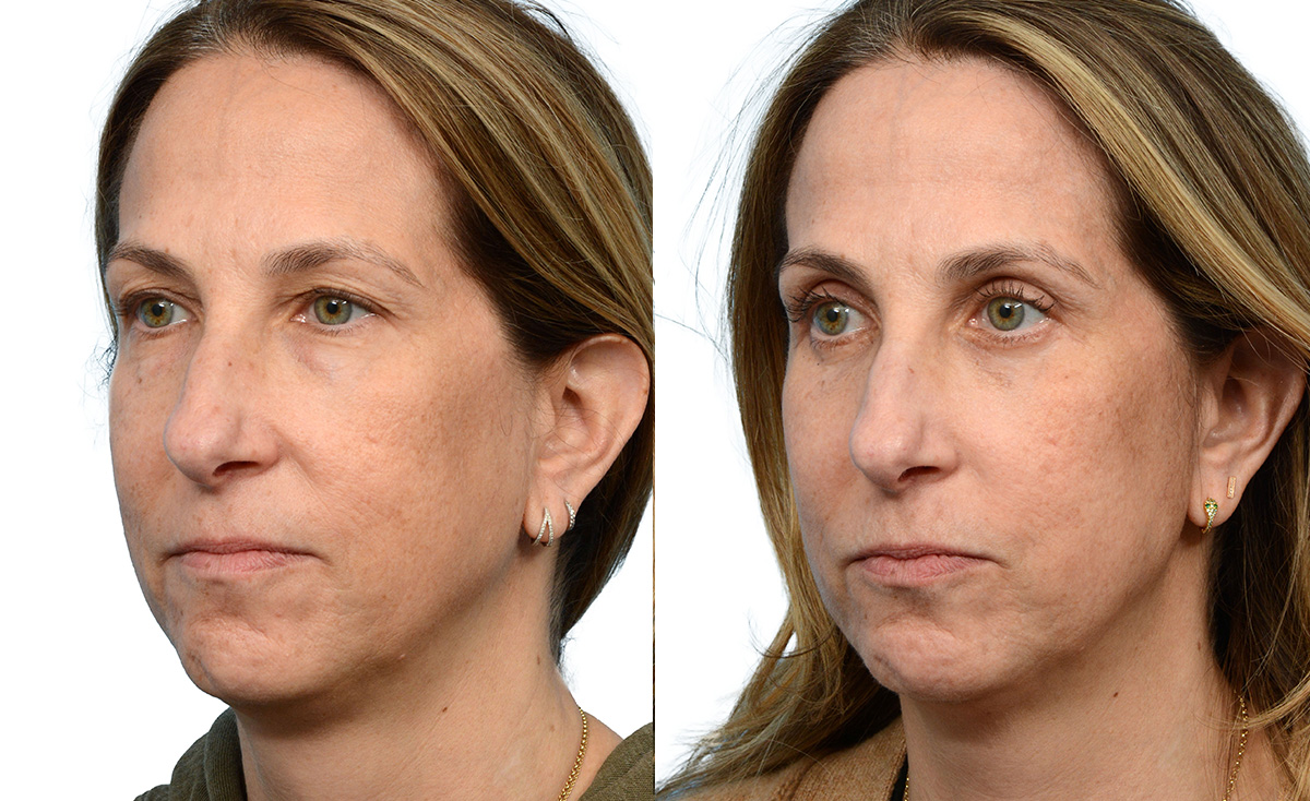 Blepharoplasty (Eyelid Surgery) Before & After Gallery - Patient 379998 - Image 4