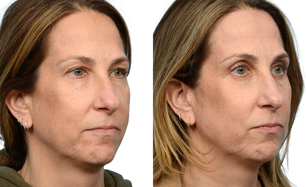 Blepharoplasty (Eyelid Surgery) Before & After Gallery - Patient 379998 - Image 2