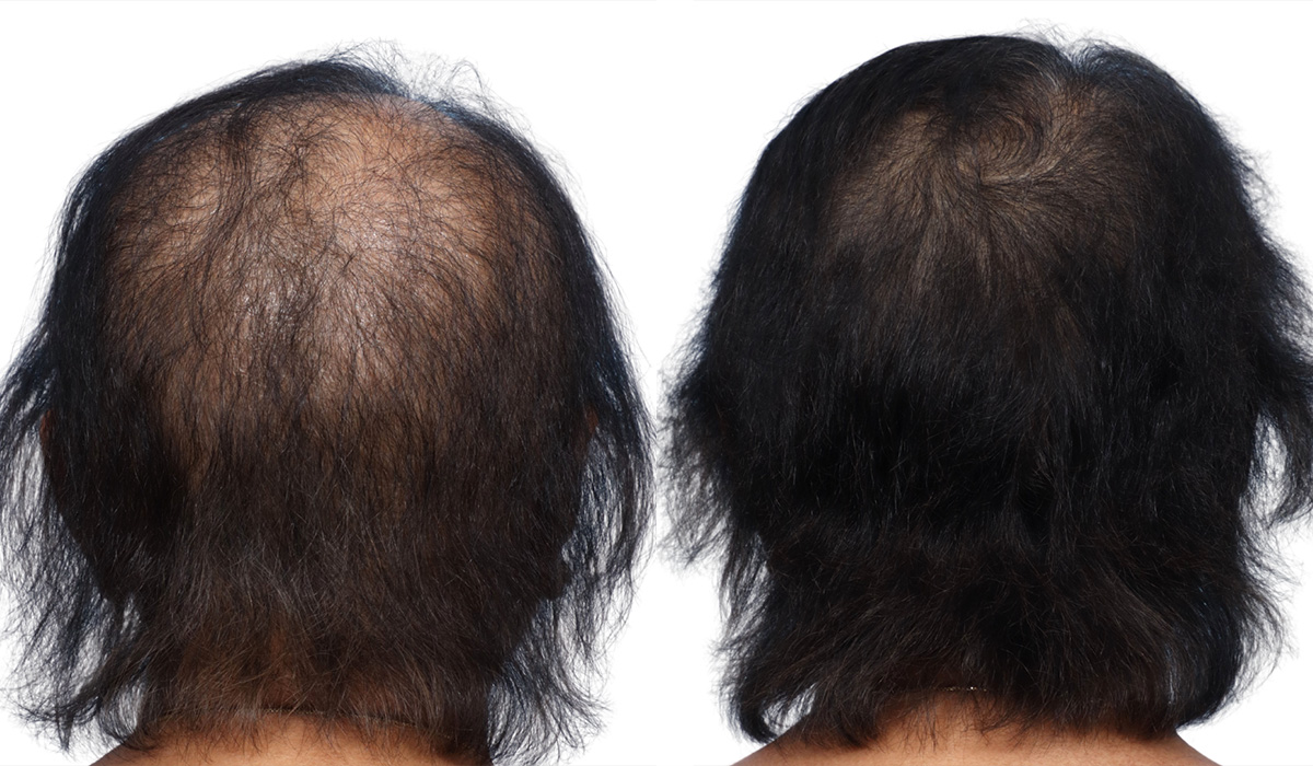 Platelet-Rich-Plasma Before & After Gallery - Patient 822984 - Image 2