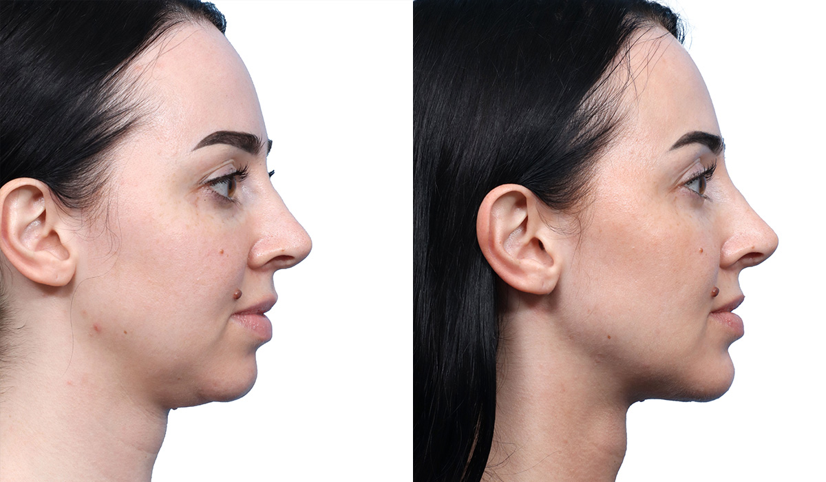 Submental Liposuction Before & After Gallery - Patient 120280 - Image 1