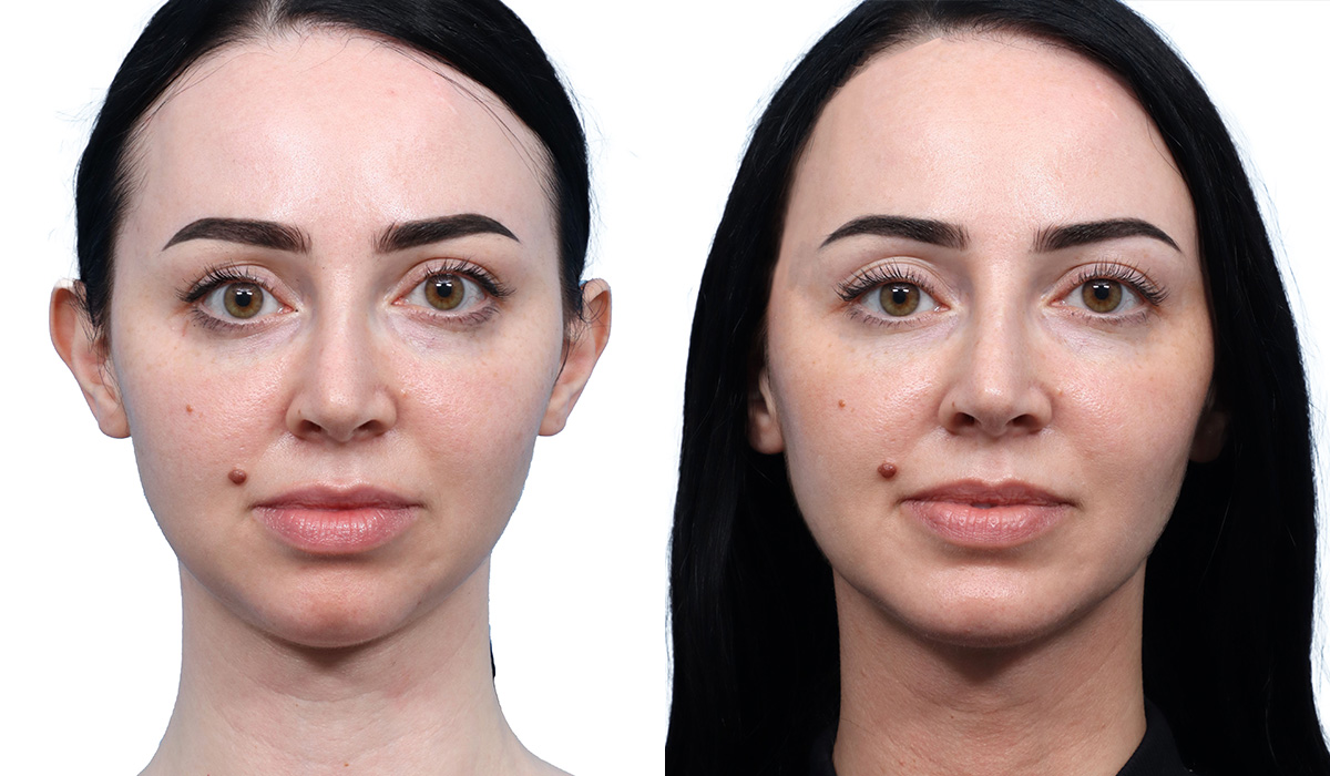 Submental Liposuction Before & After Gallery - Patient 120280 - Image 2