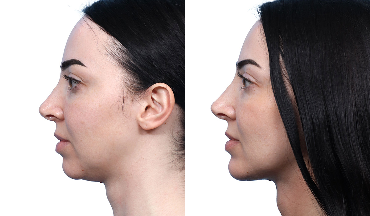 Submental Liposuction Before & After Gallery - Patient 120280 - Image 3