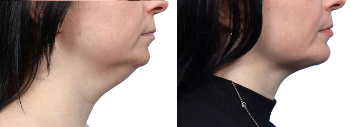 Submental Liposuction Before & After Gallery - Patient 327514 - Image 1