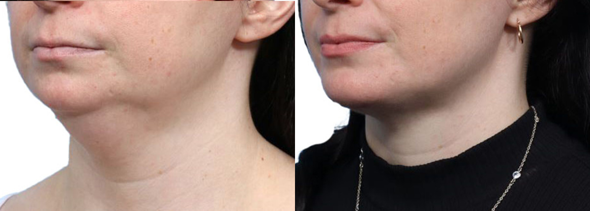 Chin Augmentation Before & After Gallery - Patient 271971 - Image 4