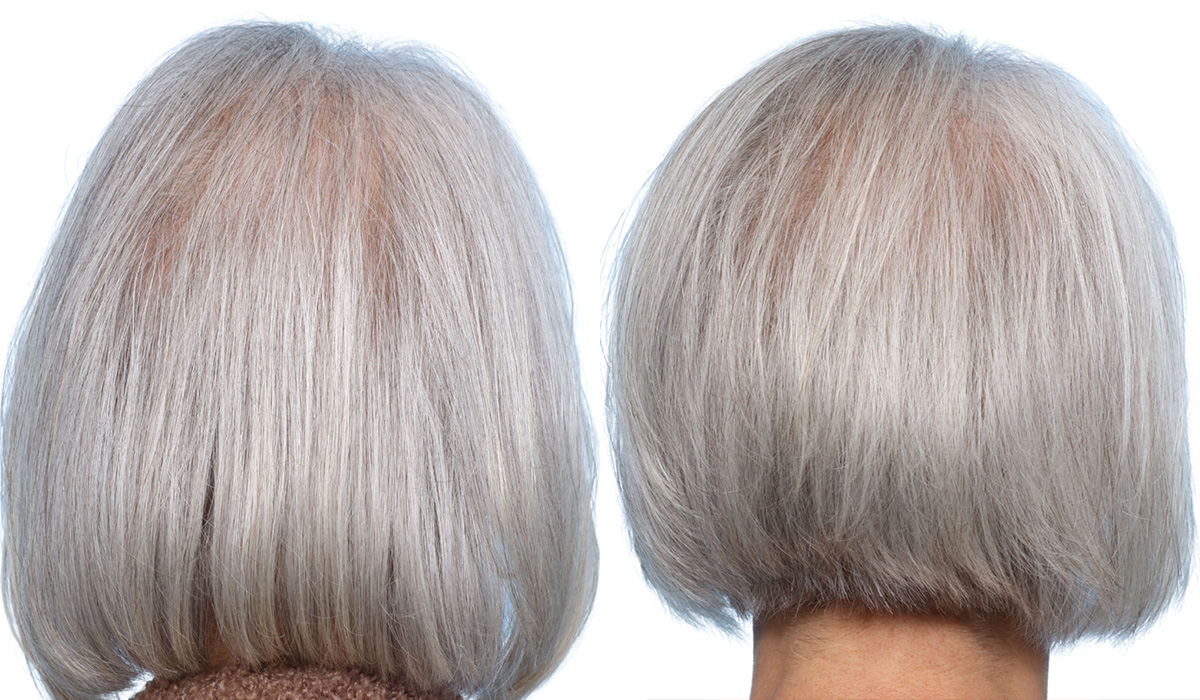 Platelet-Rich-Plasma Before & After Gallery - Patient 174059 - Image 2