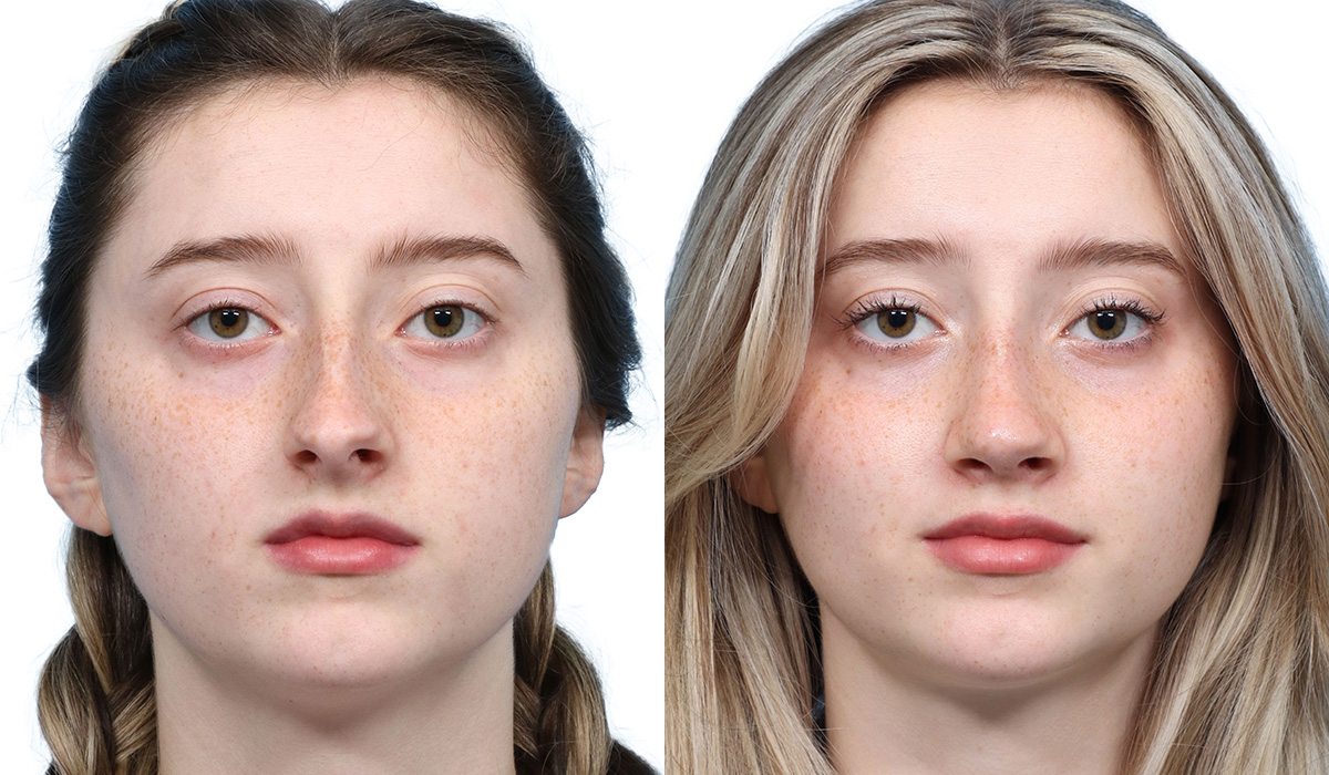 Rhinoplasty Before & After Gallery - Patient 400067 - Image 3