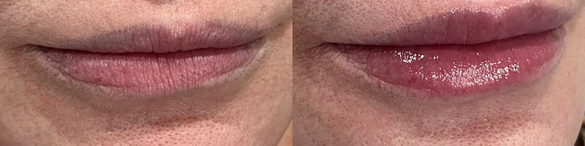 Lip Enhancement Before & After Gallery - Patient 323510 - Image 1