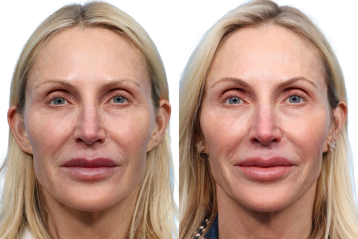 Lip Lift before and after