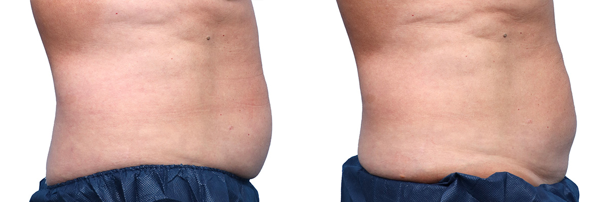 CoolSculpting® Before & After Gallery - Patient 284094 - Image 4