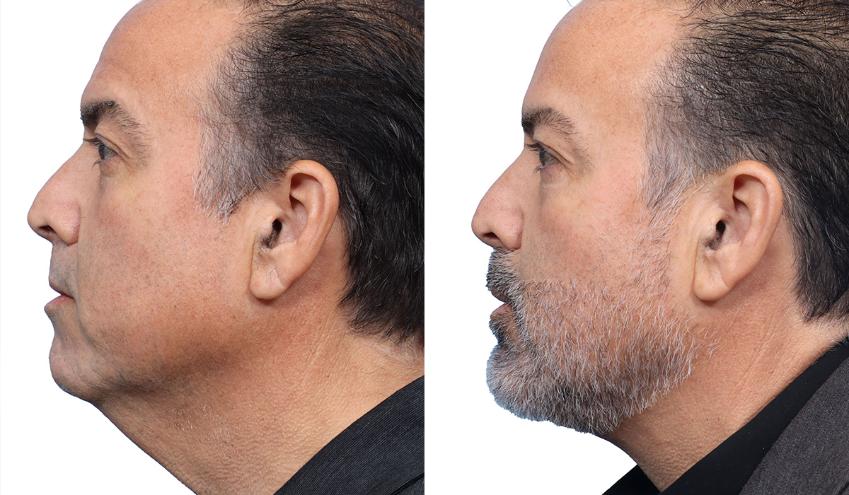 Deep Neck Lift Before & After Gallery - Patient 192190 - Image 3