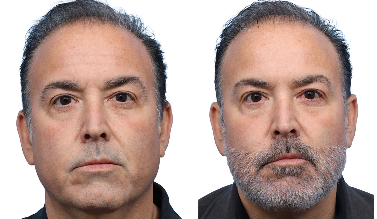Deep Neck Lift Before & After Gallery - Patient 192190 - Image 2