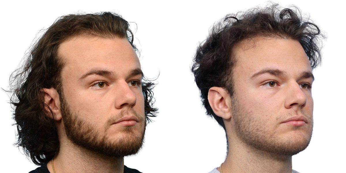 FUE Hair Transplant Before & After Gallery - Patient 284254 - Image 3
