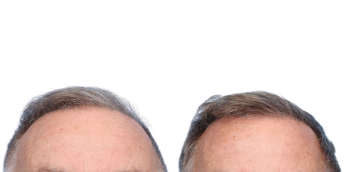 FUE Hair Transplant Before & After Gallery - Patient 200067 - Image 1