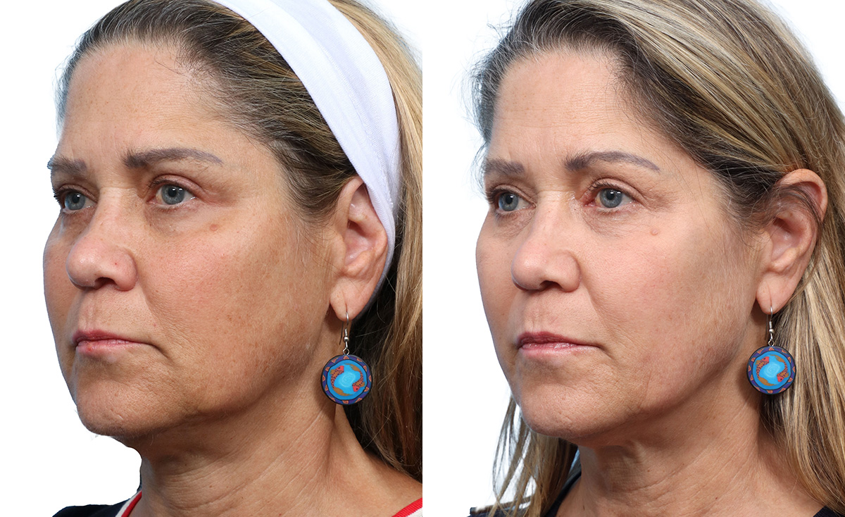Chemical Peels Before & After Gallery - Patient 157673 - Image 2
