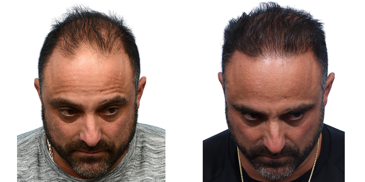 FUE Hair Transplant Before & After Gallery - Patient 240140 - Image 4