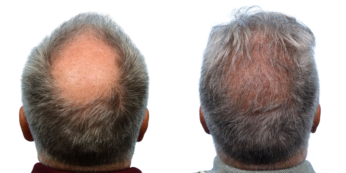 FUE Hair Transplant Before & After Gallery - Patient 361286 - Image 1