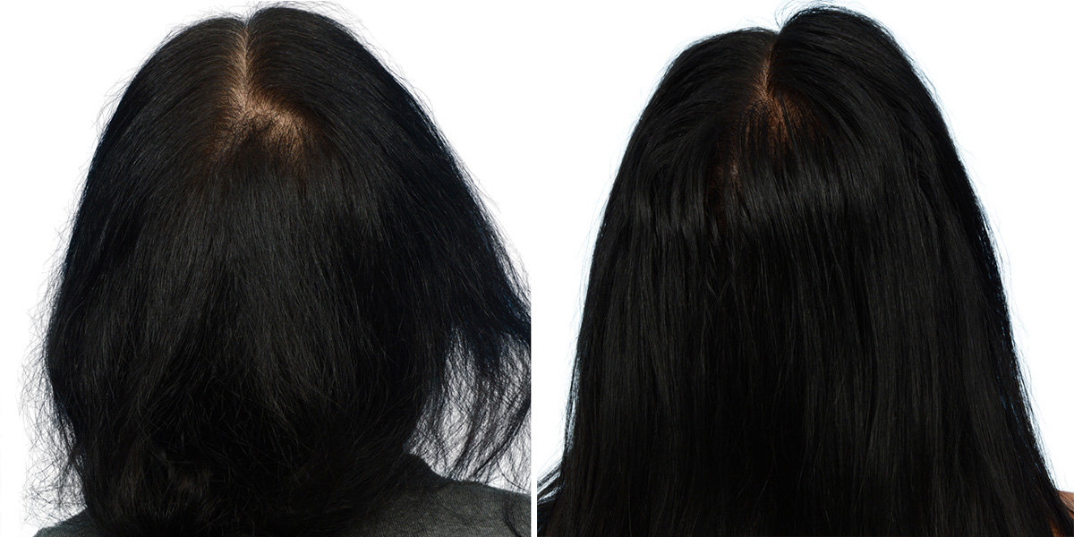 Platelet-Rich-Plasma Before & After Gallery - Patient 231477 - Image 2