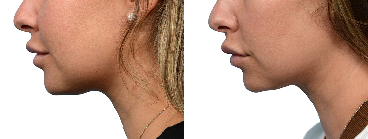 Ultherapy® Before & After Gallery - Patient 227773 - Image 4
