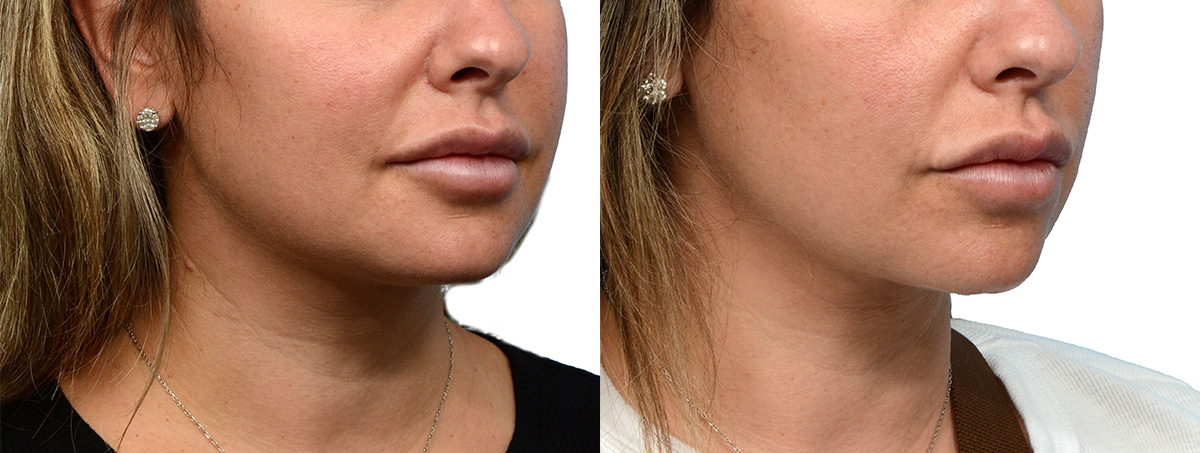 Ultherapy before and after