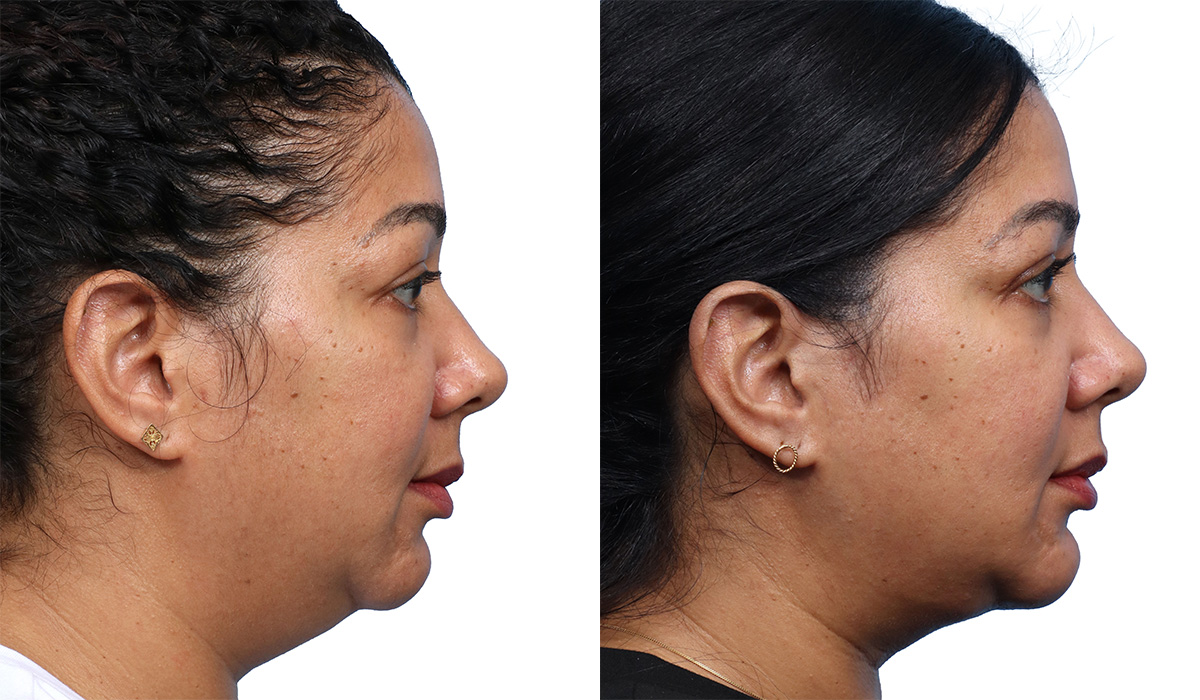 Submental Liposuction Before & After Gallery - Patient 142293 - Image 1
