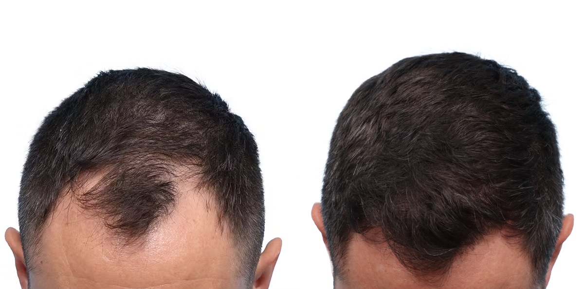 FUE Hair Transplant Before & After Gallery - Patient 276254 - Image 1