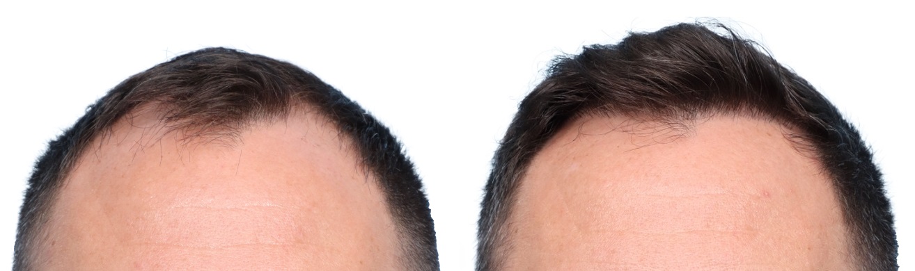FUE Hair Transplant Before & After Gallery - Patient 276254 - Image 2