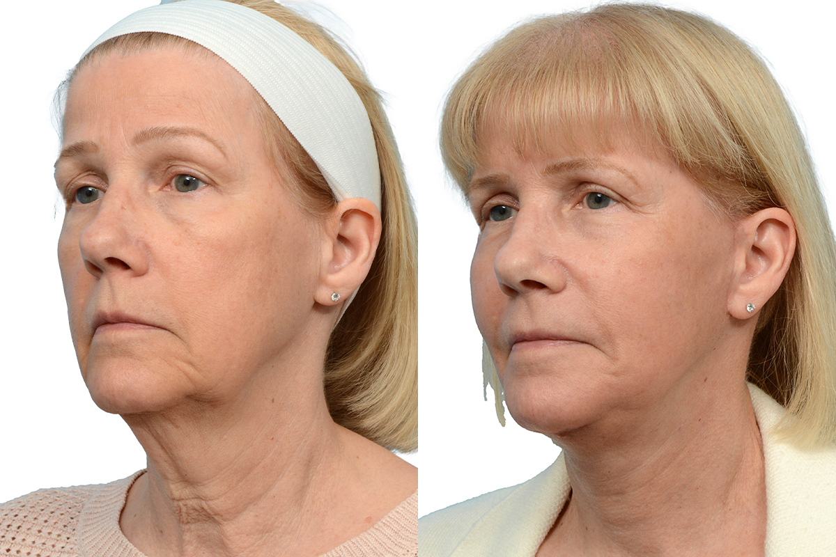 Deep Plane Facelift Before & After Gallery - Patient 333849 - Image 2