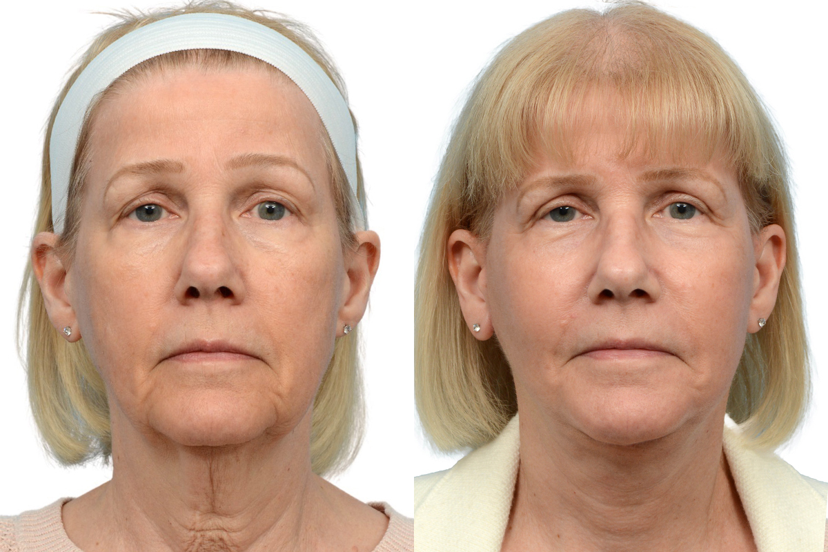 Facial Fat Transfer Before & After Gallery - Patient 166427 - Image 1