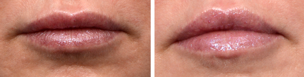 Lip Lift before and after
