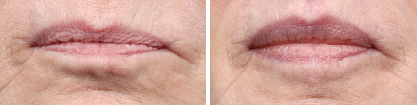 Lip Lift before and after