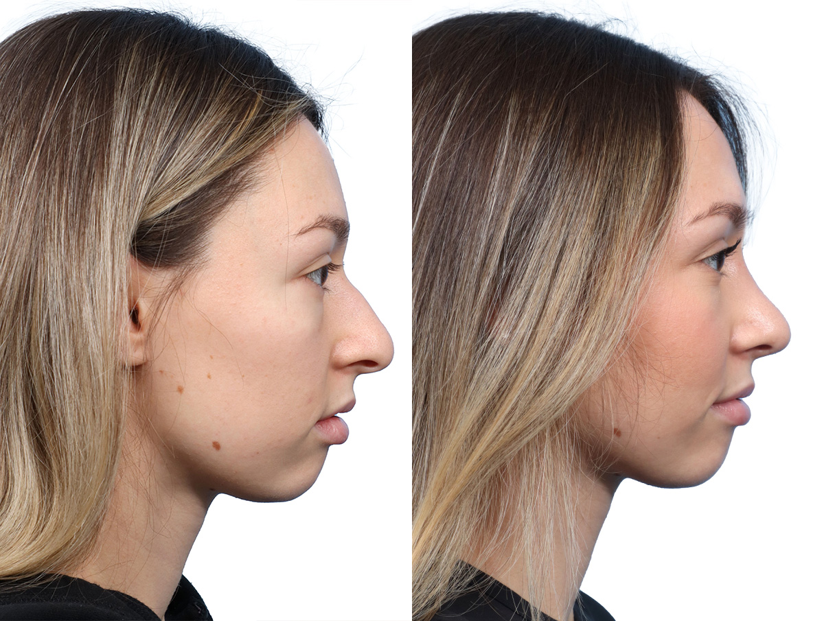 Rhinoplasty Before & After Gallery - Patient 246514 - Image 1