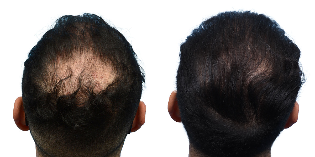 FUE Hair Transplant Before & After Gallery - Patient 272833 - Image 2