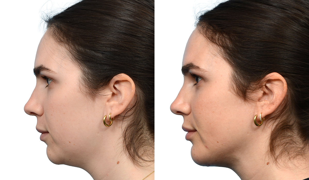 Chin Augmentation Before & After Gallery - Patient 376593 - Image 3