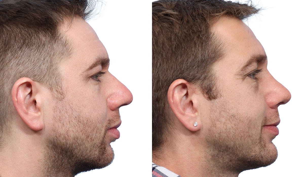 Rhinoplasty Before & After Gallery - Patient 677760 - Image 1