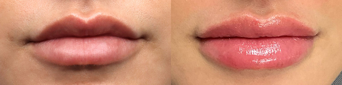 Lip Enhancement Before & After Gallery - Patient 497957 - Image 1