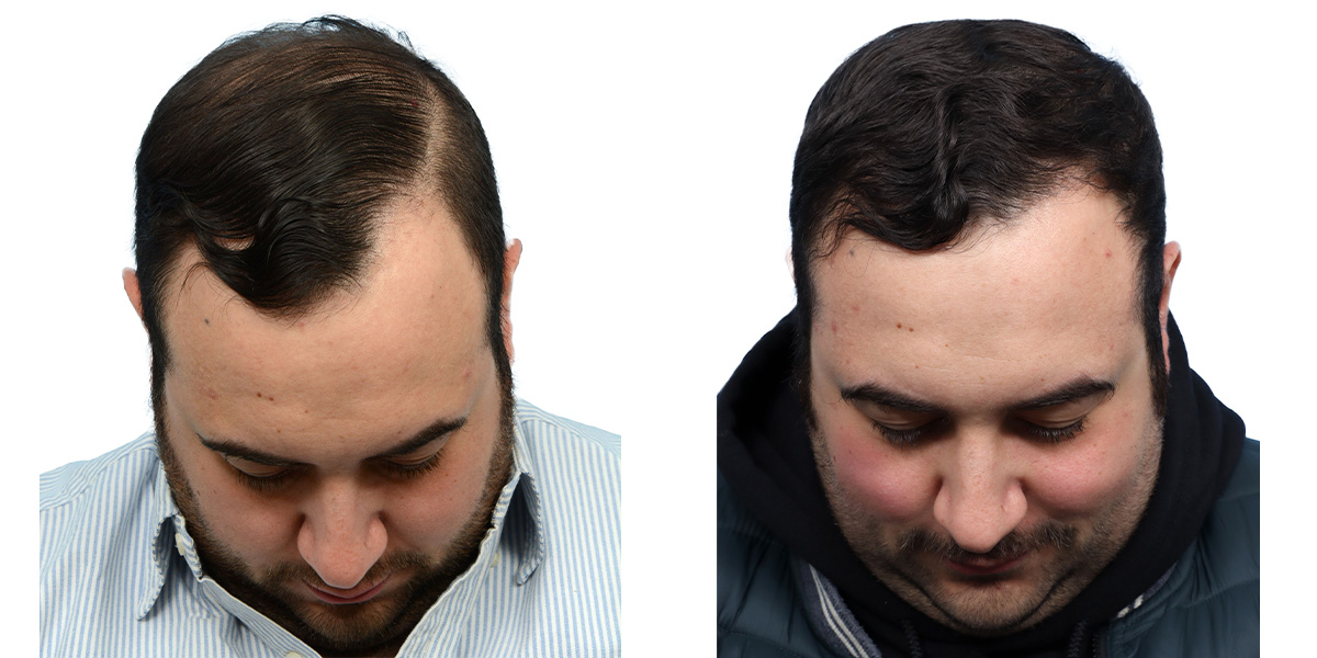 FUE Hair Transplant Before & After Gallery - Patient 149353 - Image 2