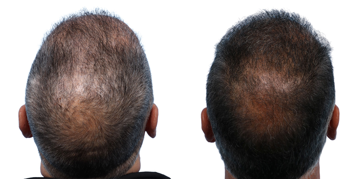 FUE Hair Transplant Before & After Gallery - Patient 867011 - Image 1