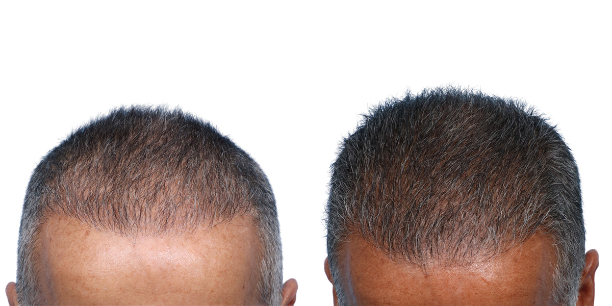 FUE Hair Transplant Before & After Gallery - Patient 867011 - Image 2