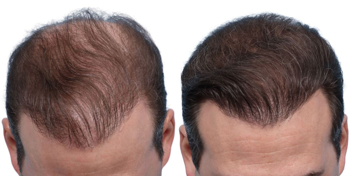 FUE Hair Transplant Before & After Gallery - Patient 371199 - Image 2