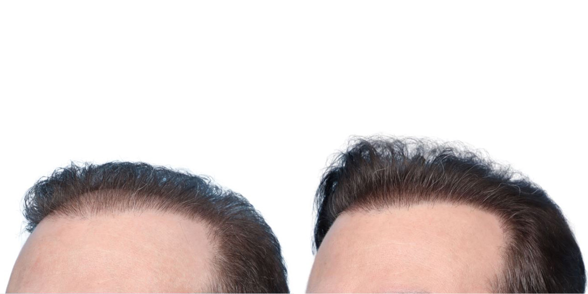 FUE Hair Transplant Before & After Gallery - Patient 371199 - Image 5