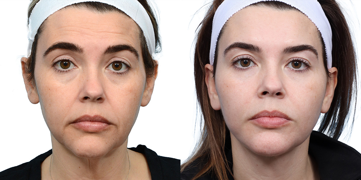 Facial Fat Transfer Before & After Gallery - Patient 253780 - Image 1