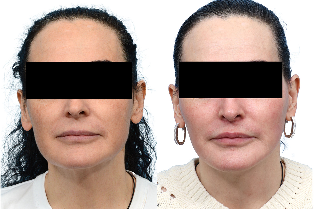 Facial Fat Transfer Before & After Gallery - Patient 400928 - Image 1