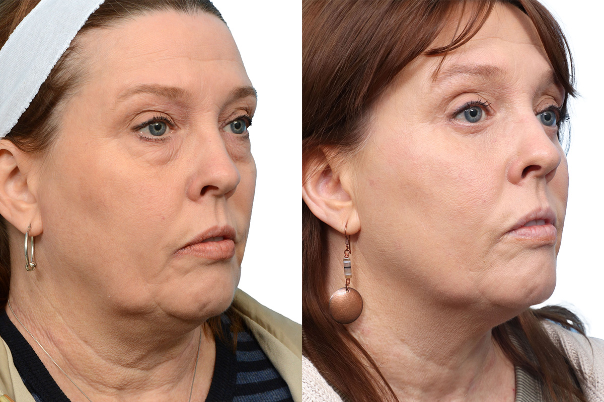 Blepharoplasty (Eyelid Surgery) Before & After Gallery - Patient 276187 - Image 2