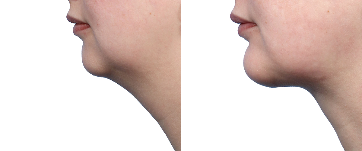Submentoplasty Before & After Gallery - Patient 181819 - Image 2